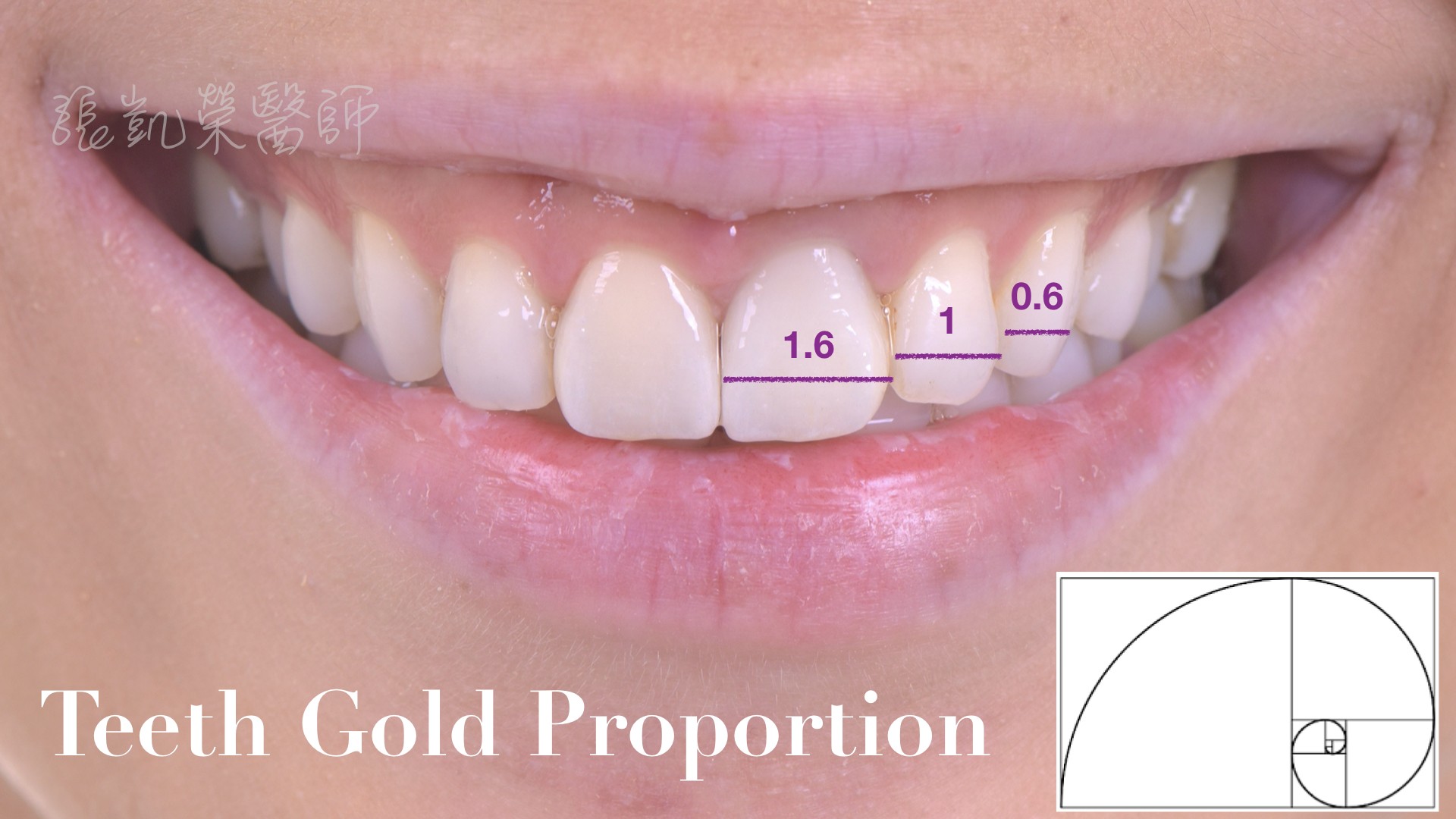 什麼是微笑曲線？ part IＩ：牙齒比例好，整齊排排乖乖站